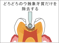 3Mix-MP法のむし歯治療のイラスト/ 
